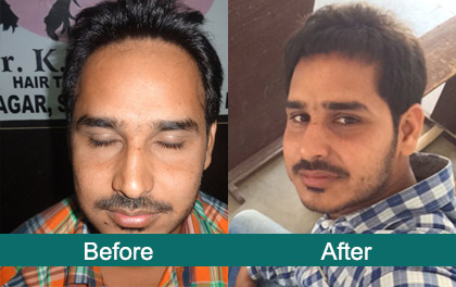 Satyam Hair Transplant Centre - Hair Restoration Clinic in Ludhiana,  Ludhiana, India 